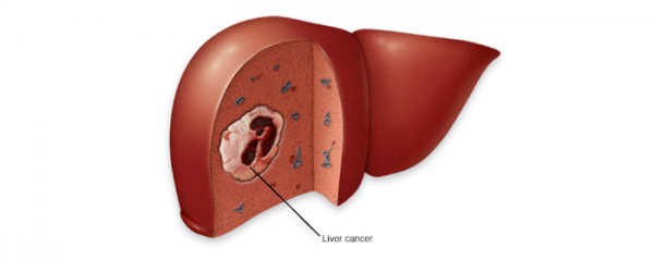 C型肝炎療程後發現巨大肝癌
